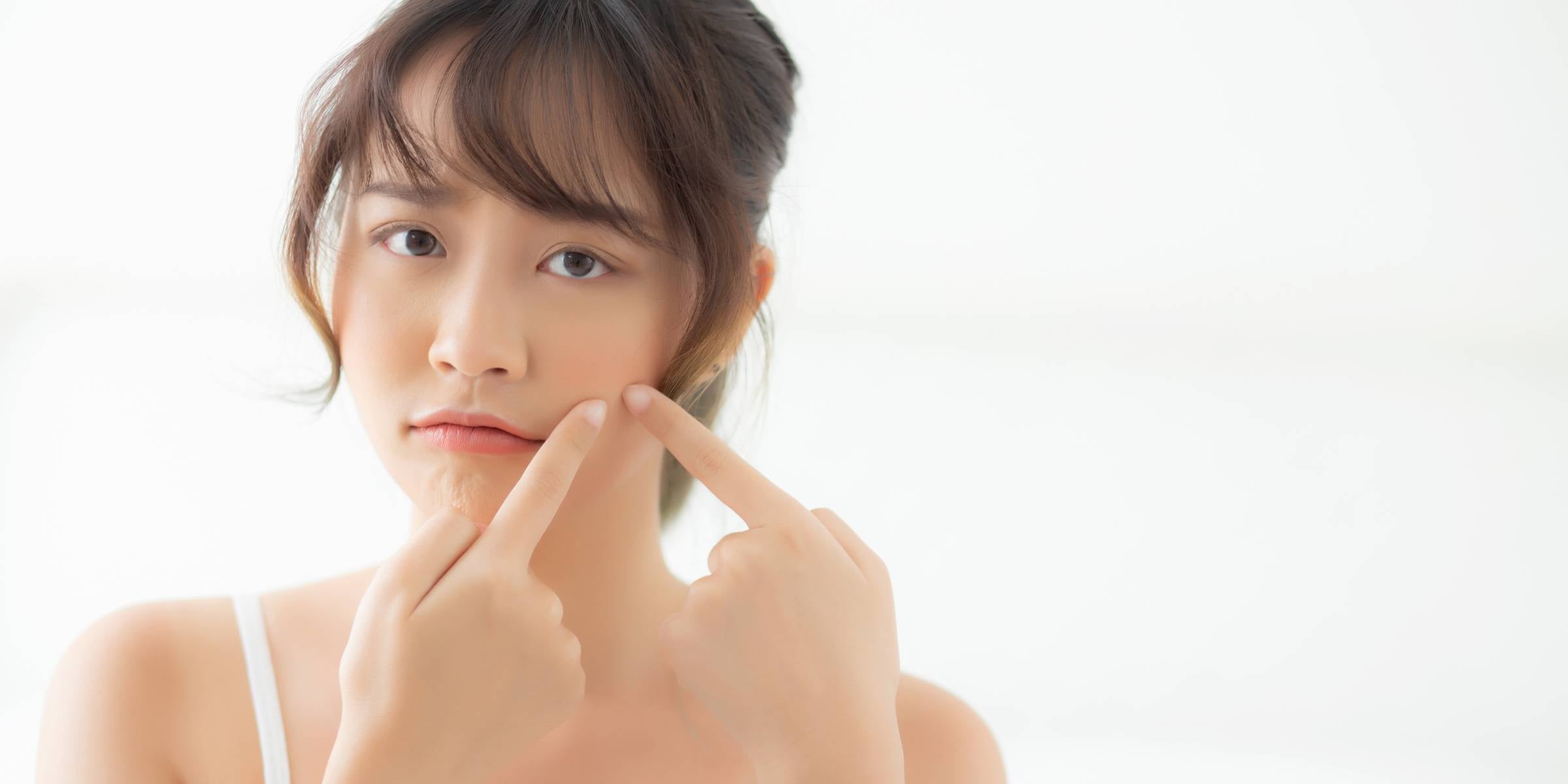Acne Prone Skin