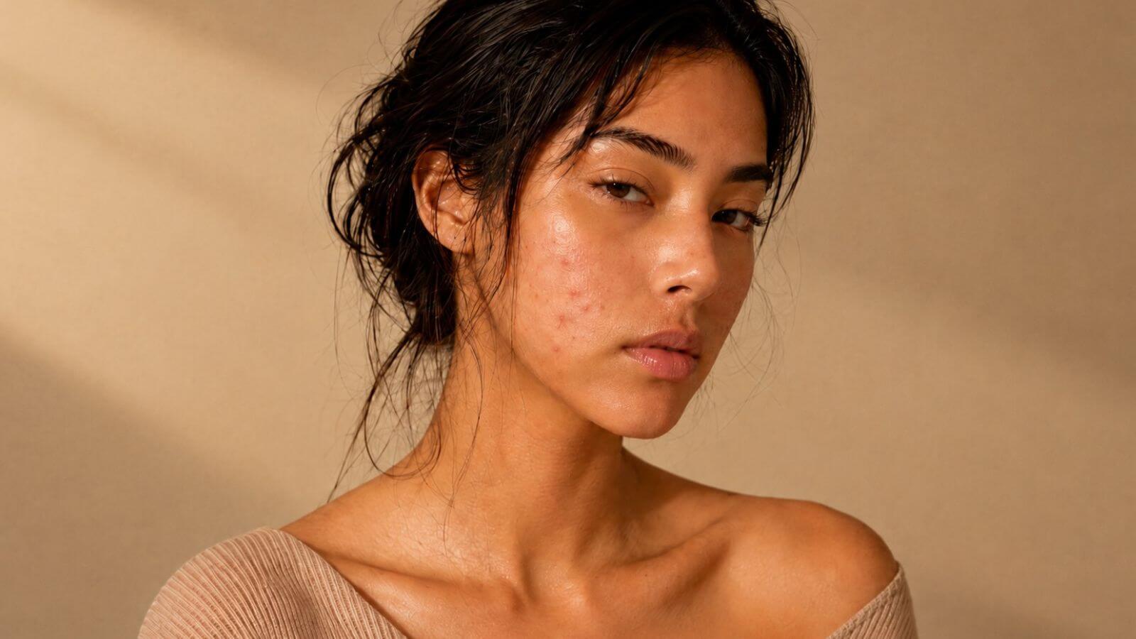 Editorial skincare image for acne-prone skin